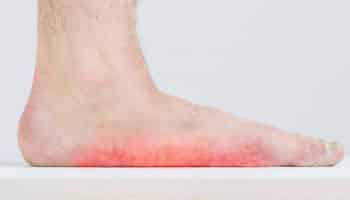 Adult Acquired Flatfoot