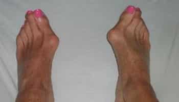 Bunions