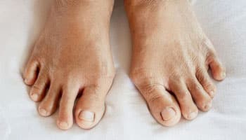 Foot Arthritis