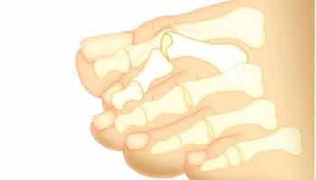 Hammertoe Treatment