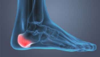 Heal Spur Syndrome