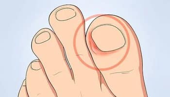 Ingrown Toenails