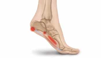 Plantar Fasciitis