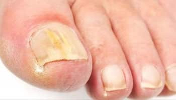 Toenail Fungus
