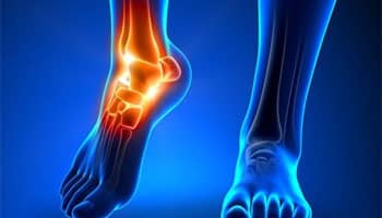 Ankle Pain