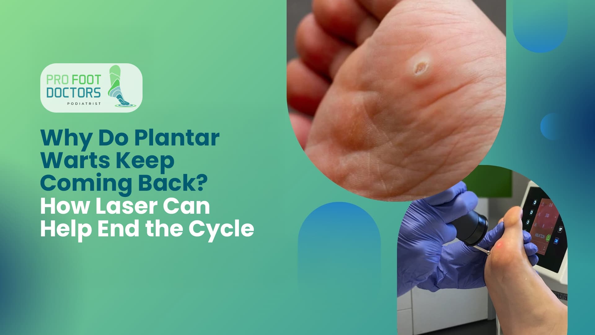 Why Plantar Wart Keep Coming Back? How Laser Can Help