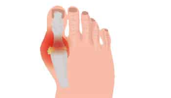 Gout