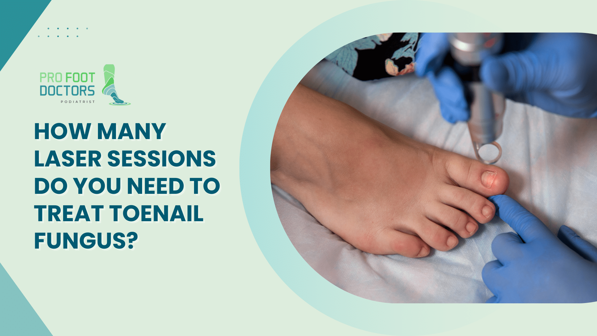 How Many Laser Sessions Do You Need to Treat Toenail Fungus?