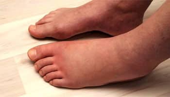 Swollen Legs & Ankle