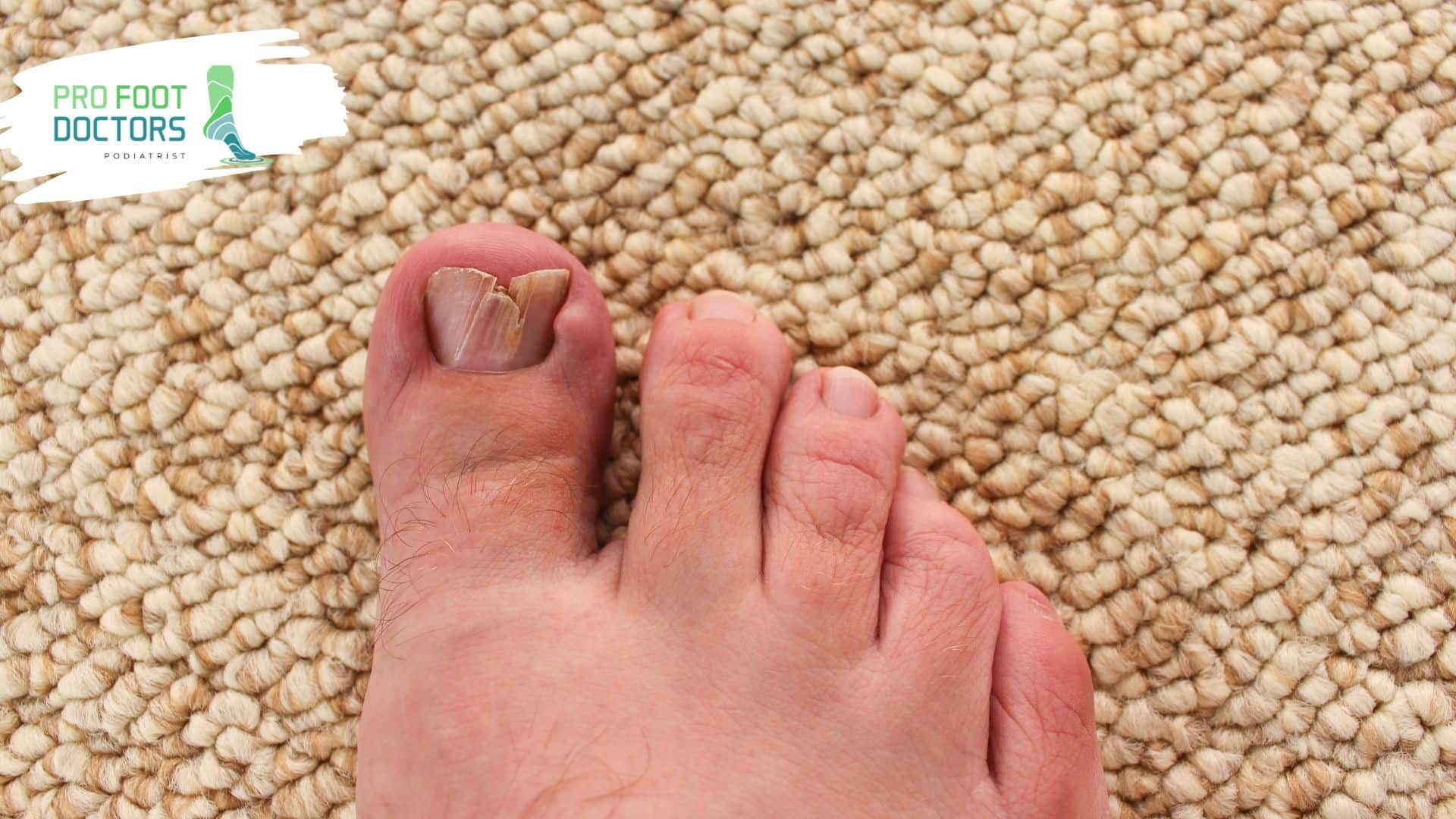 Time to visit a doctor - Deformation of Nail or Toe