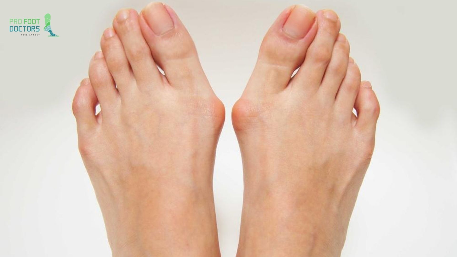 What Are Bunions ? Pro Foot doctors