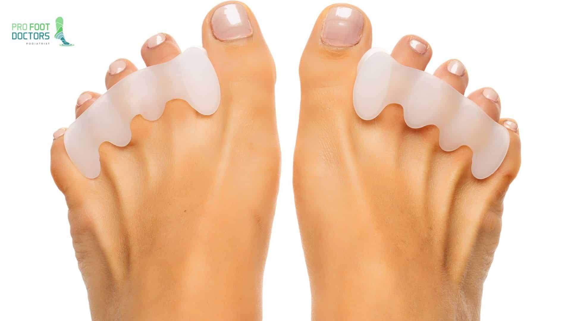 What are toe spacers? Pro Foot Doctors