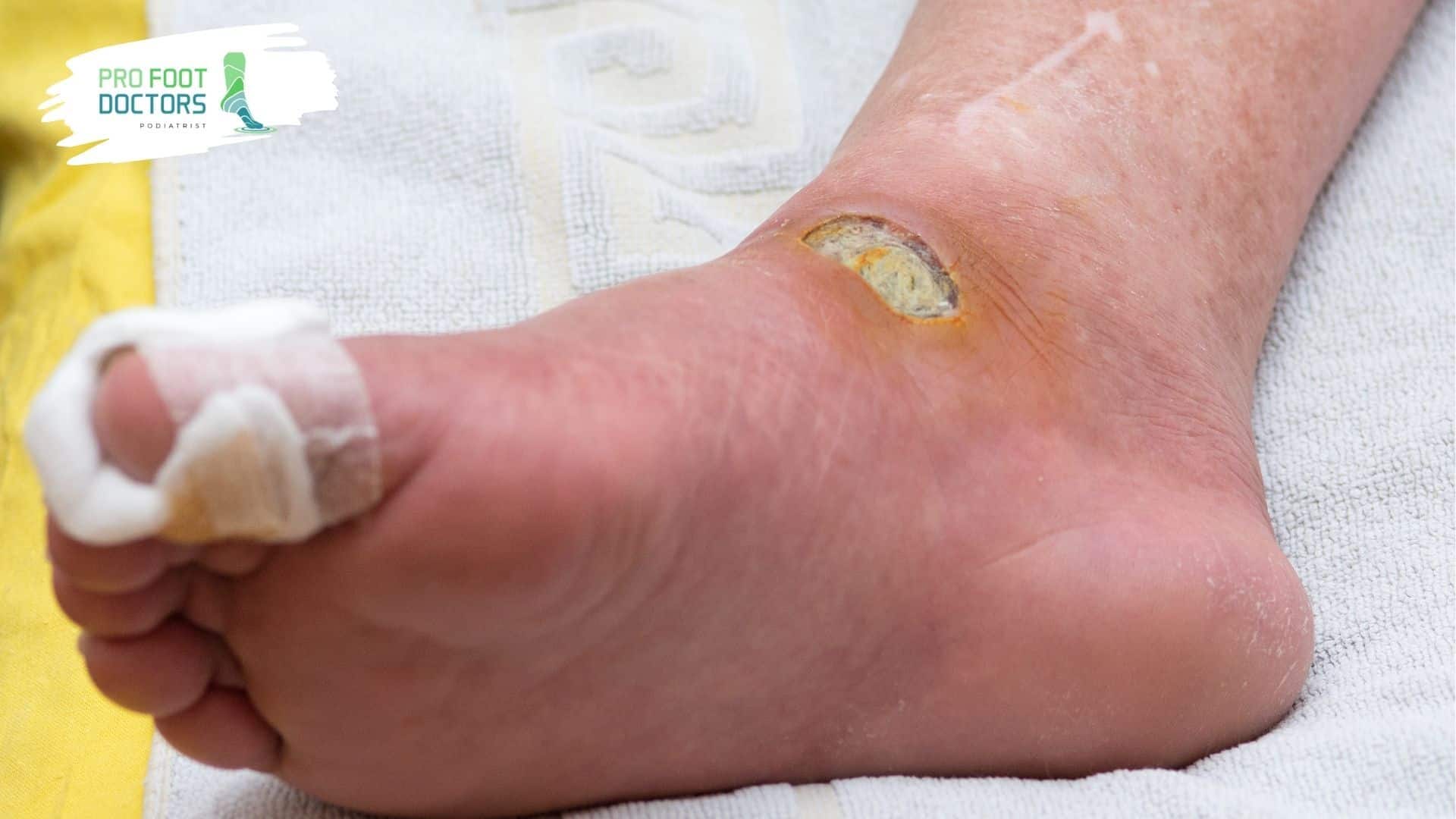 Why is Debridement Important for Diabetic Foot Wounds?