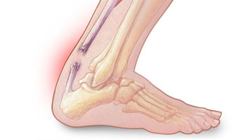 Achilles Tendon