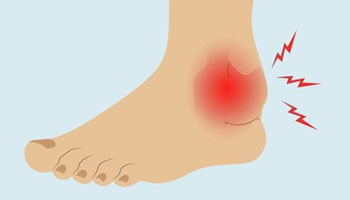 Ankle Arthritis