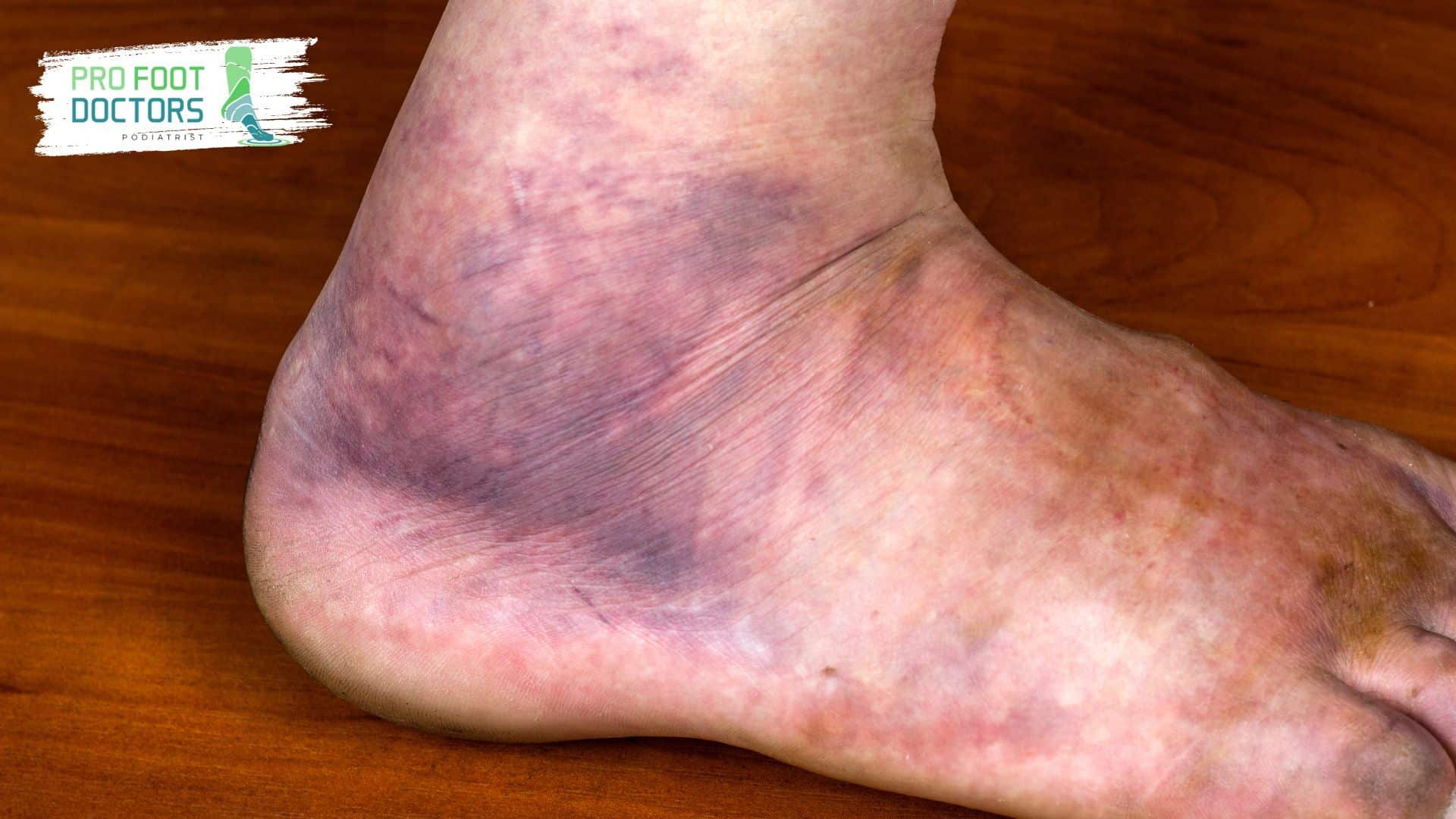 Bruising or misalignment of ankle -  Pro Foot Doctors