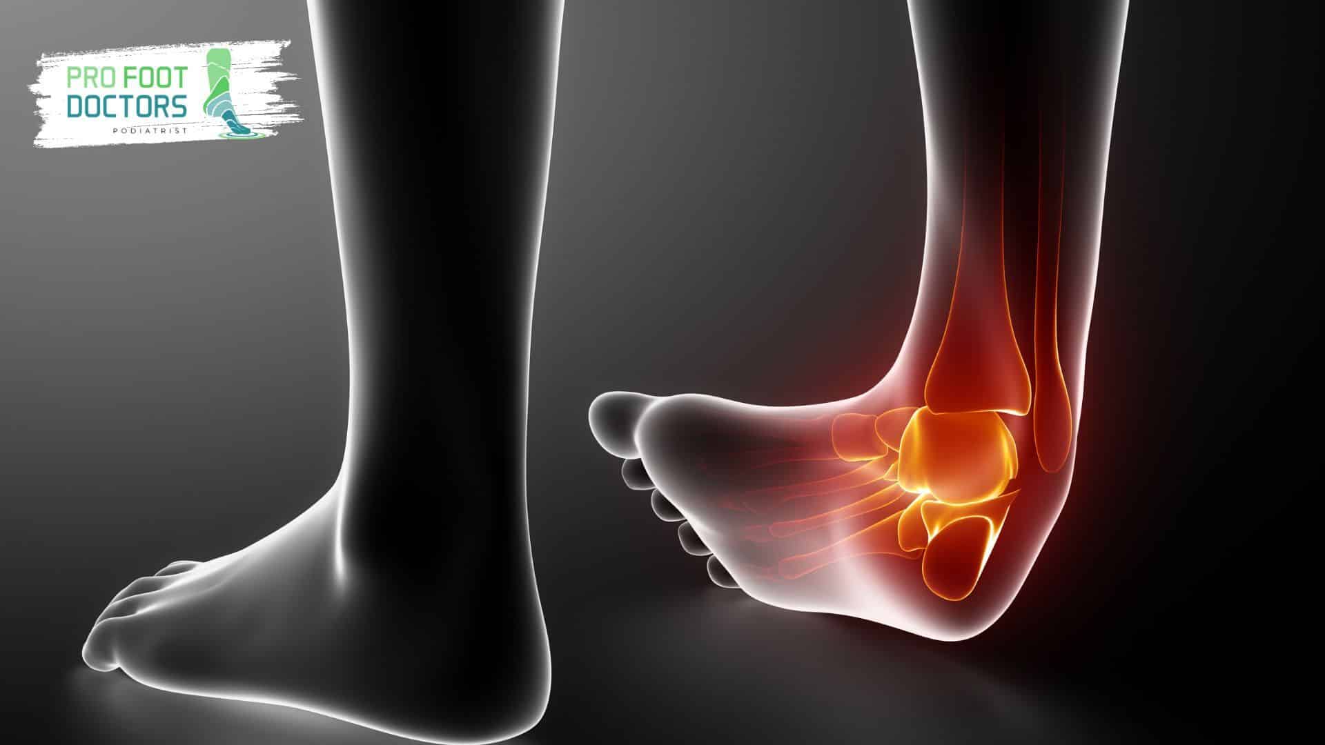 Causes of a sprained ankle