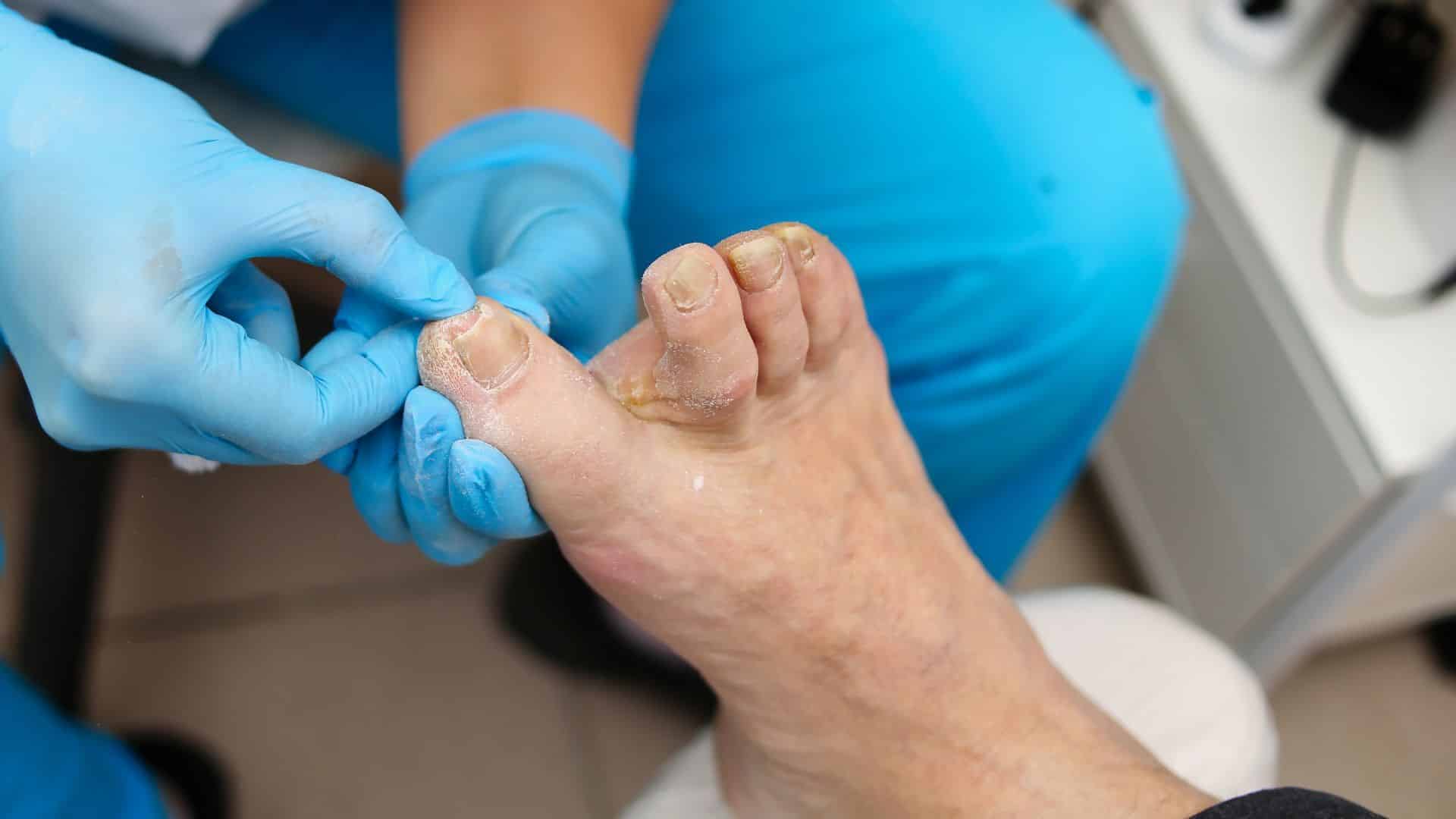 How medical intervention helps in curing ingrown toenails