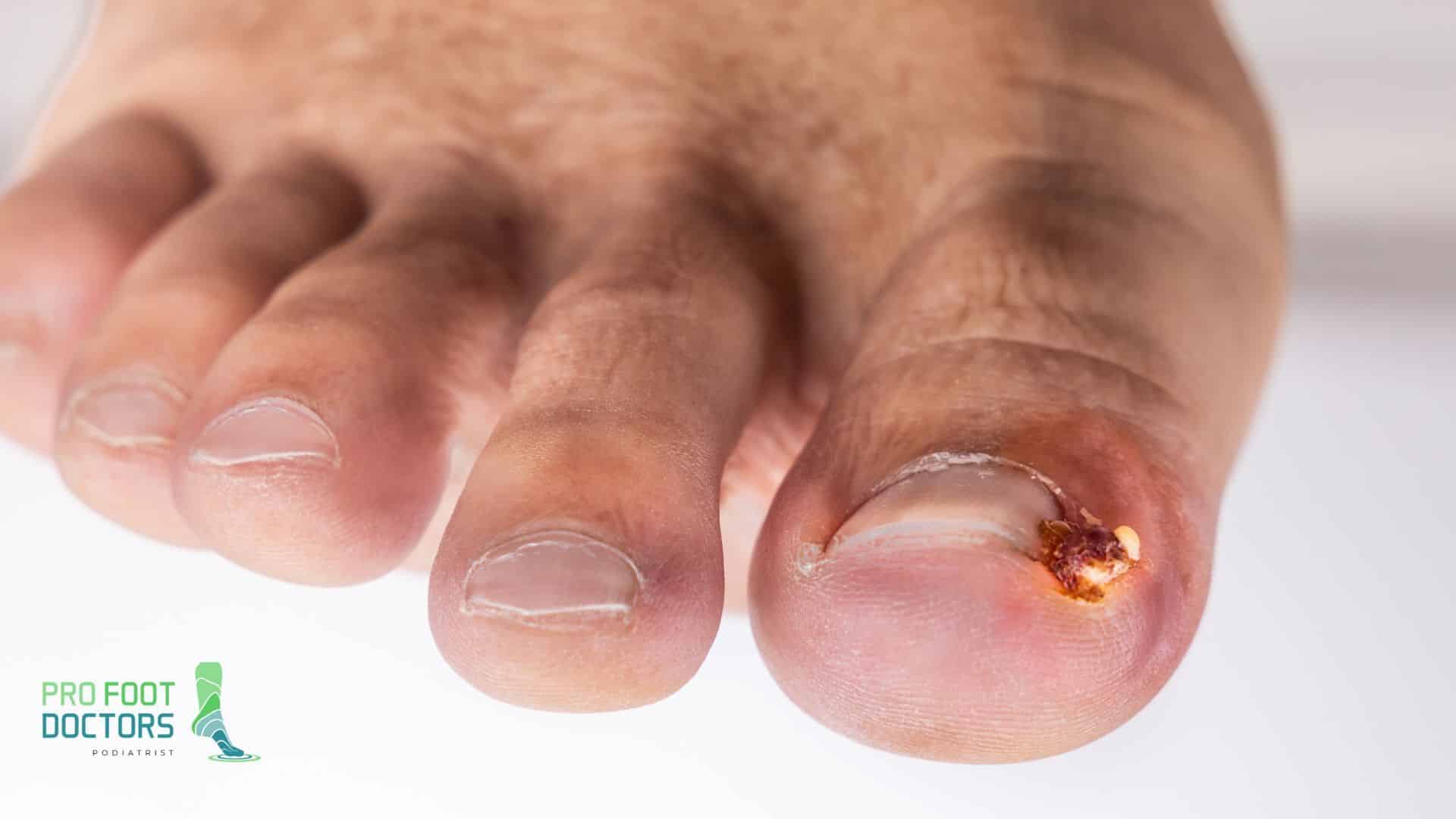Signs of infection - Pro Foot Doctors