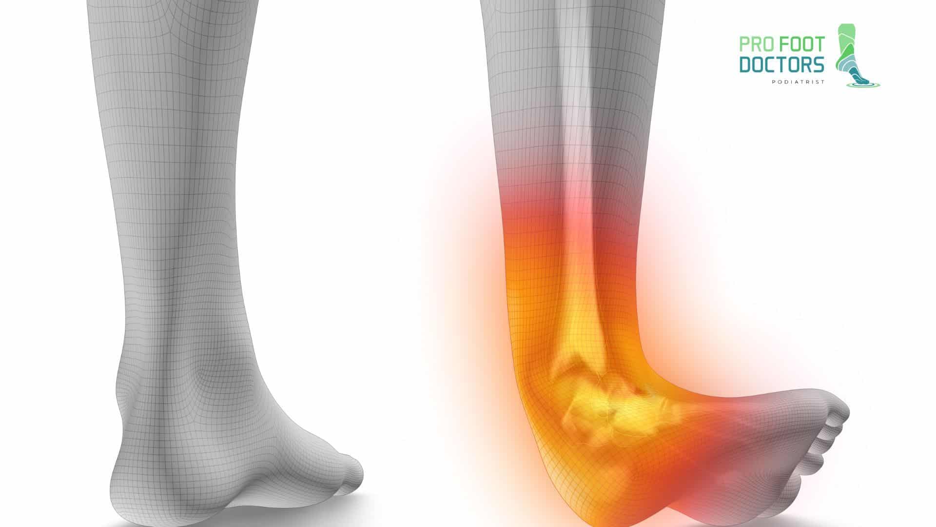 Sprained Ankle vs. Broken Ankle