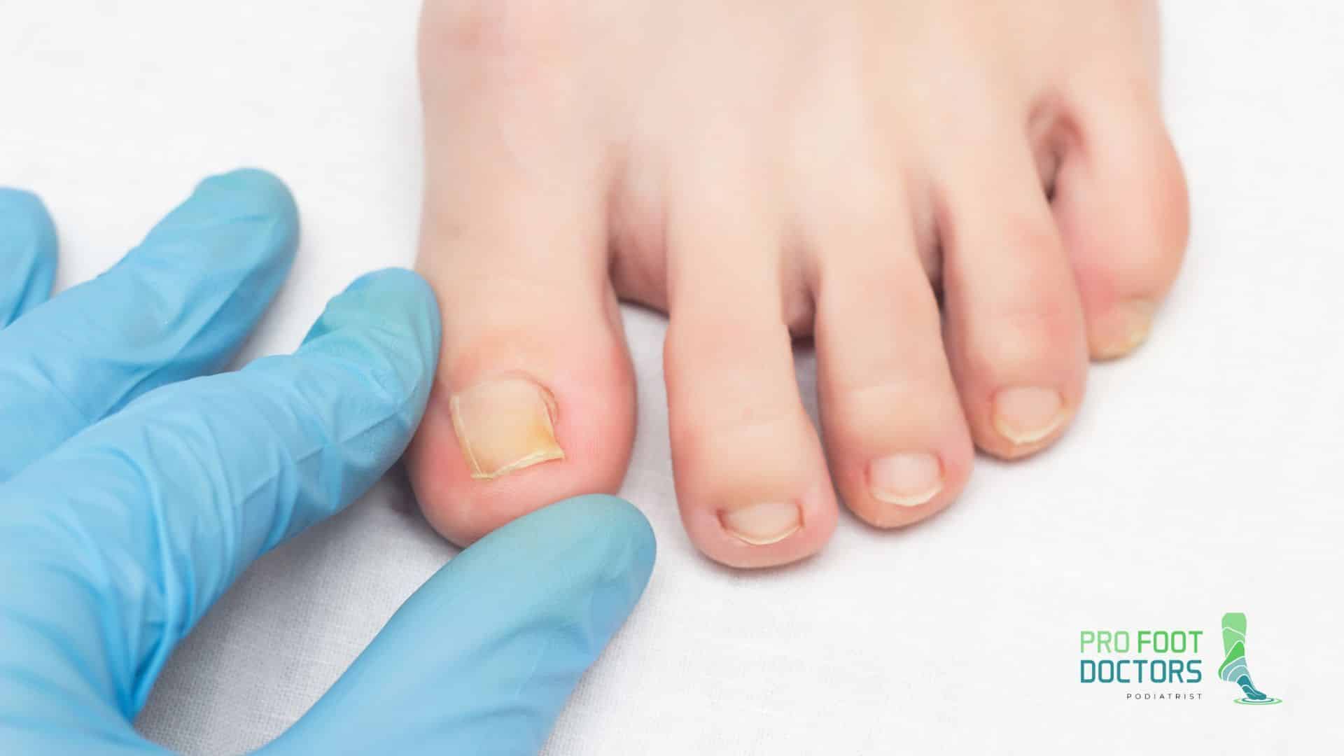 When does footwear lead to ingrown toenails?