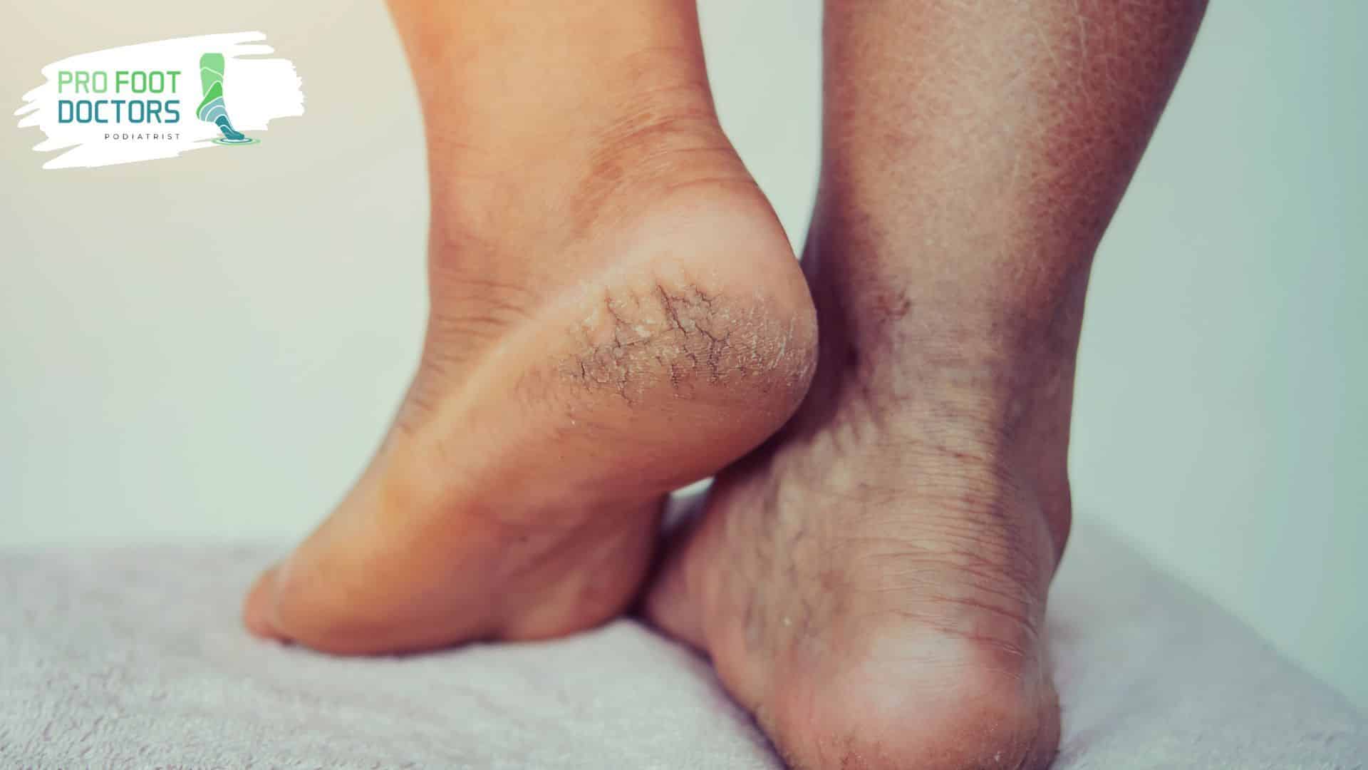 Why Do Diabetics Get Dry, Cracked Feet?  