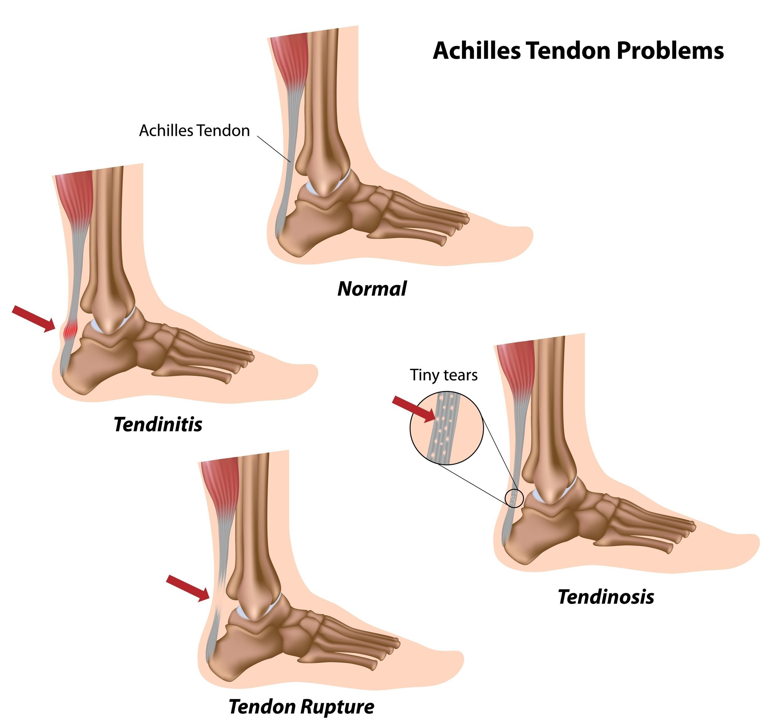 Types of achilles tendon problems
