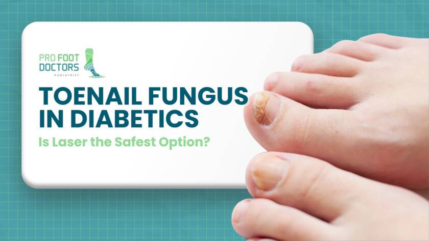 Toenail Fungus in Diabetics Is Laser the Safest Option