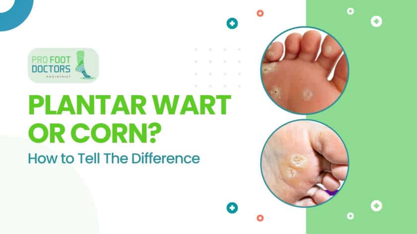 Plantar Wart or Corn Here’s How to Tell and Why It Matters for Treatment