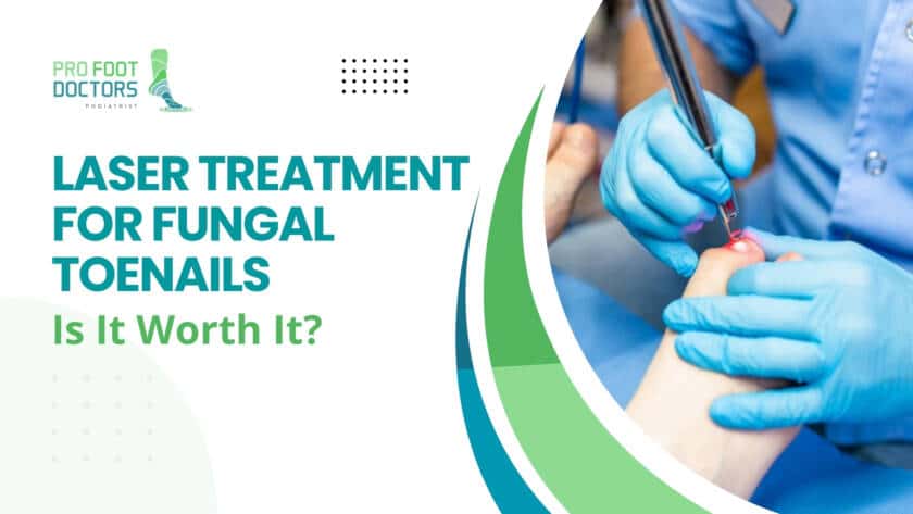 Laser Treatment for Fungal Toenails-Is It Worth It